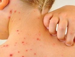 Campak Jauh Lebih Menular dari Covid-19